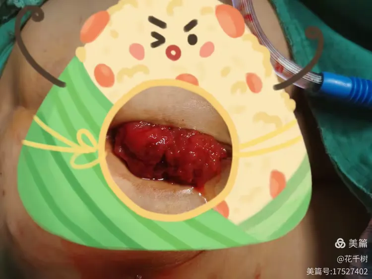 病例科普:直肠绒毛状腺瘤